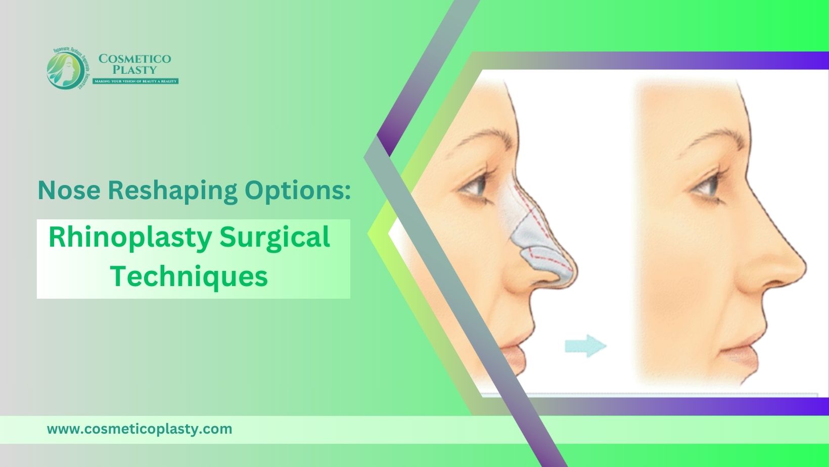 Nose Reshaping Options: Rhinoplasty Surgical Techniques