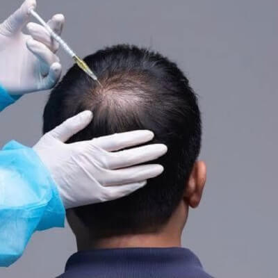 What Is the Average Hair Growth Rate After Hair Transplant?