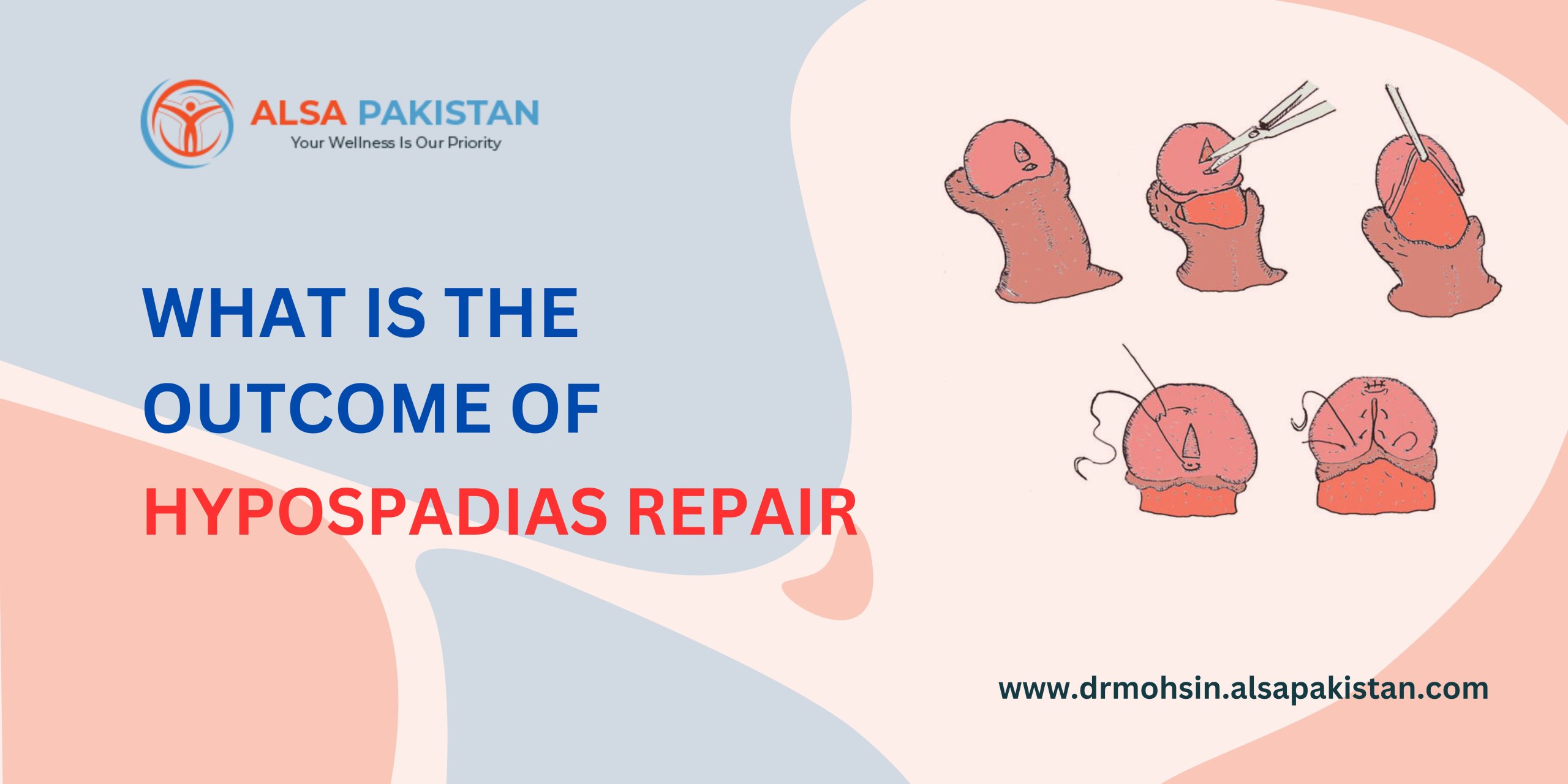 What is the outcome of hypospadias repair