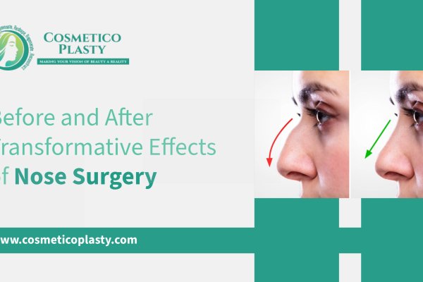 Before and After Transformative Effects of Nose Surgery