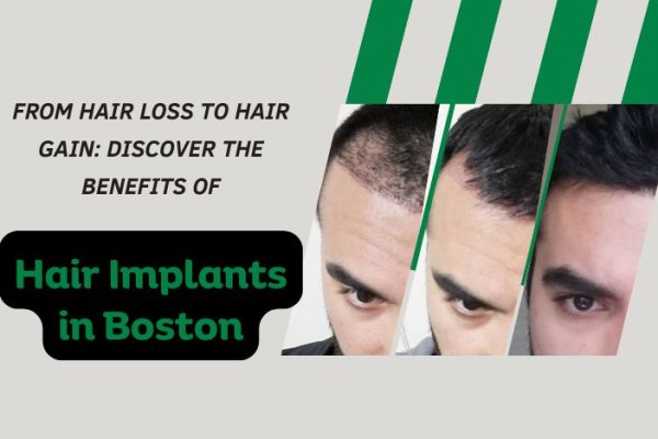 From-Hair-Loss-to-Hair-Gain-Discover-the-Benefits-of-Hair-Implants-in-Boston